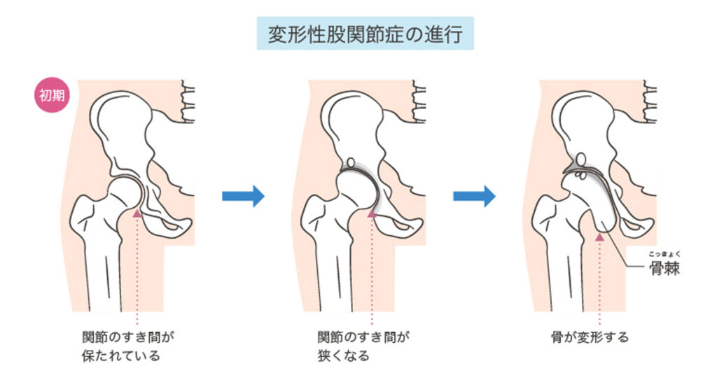 変形性股関節症の進行