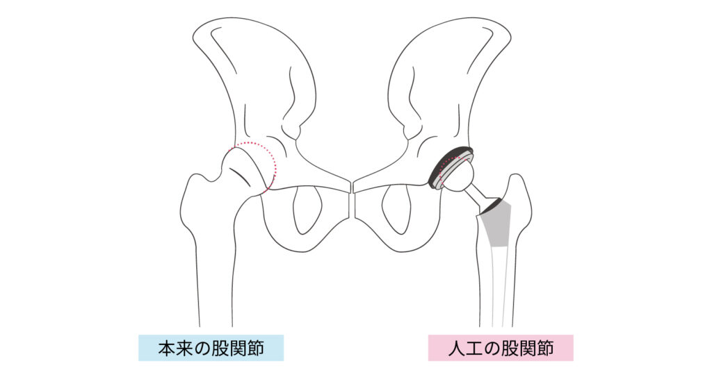 人工股関節置換術