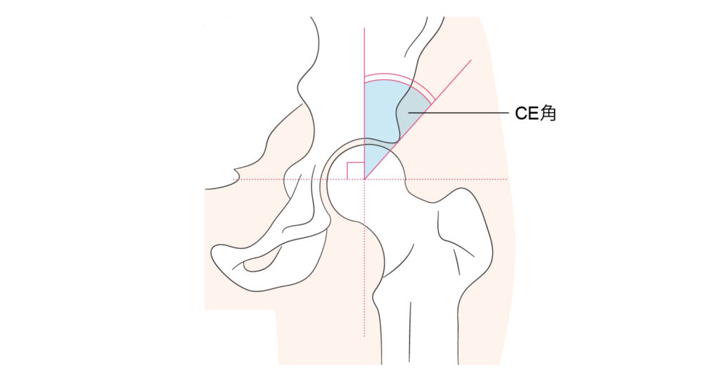 臼蓋形成不全（CE角）