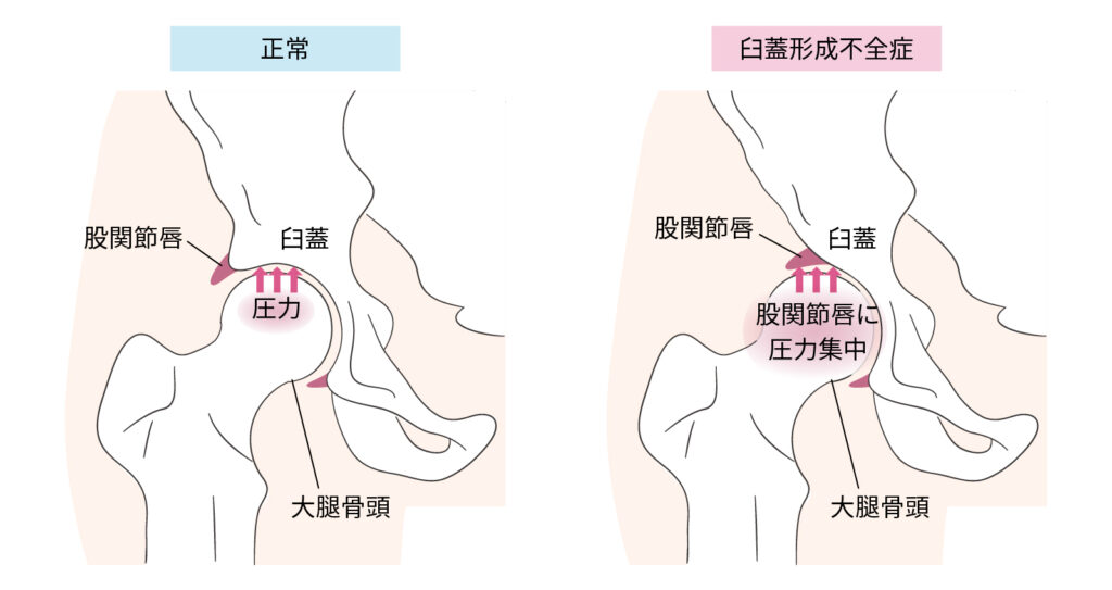 臼蓋形成不全