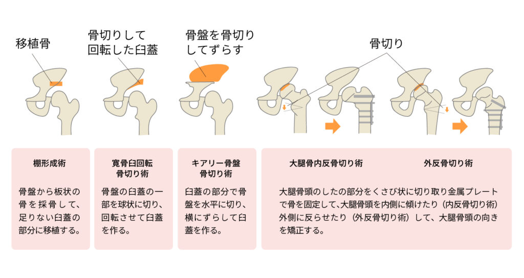 関節温存手術（骨切り術）