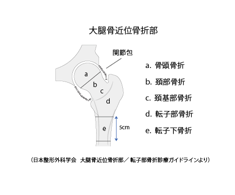 大腿骨近位骨折部