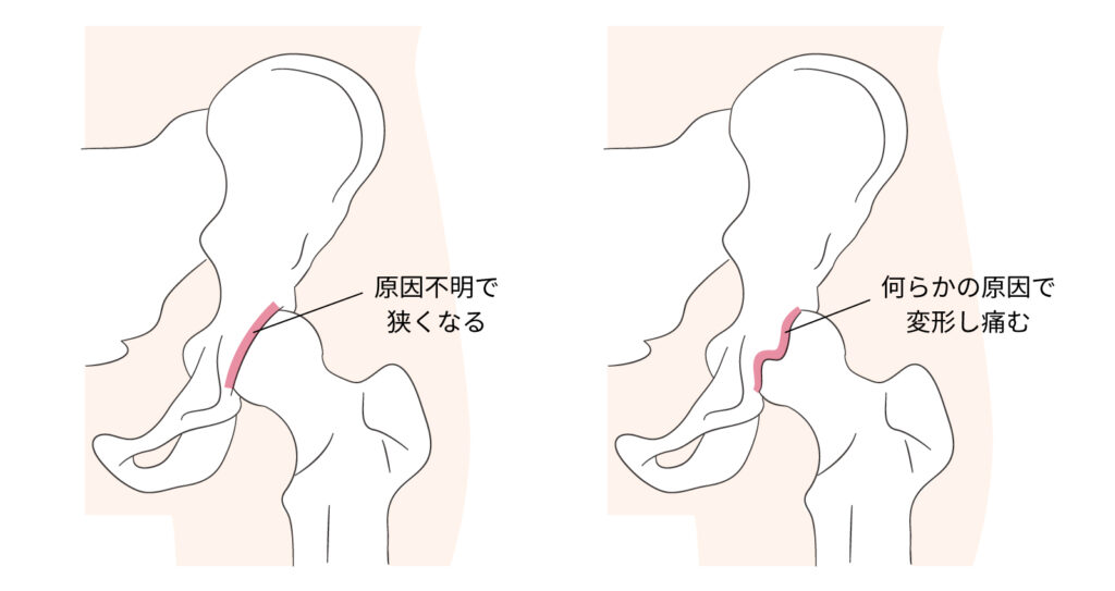 変形性股関節症