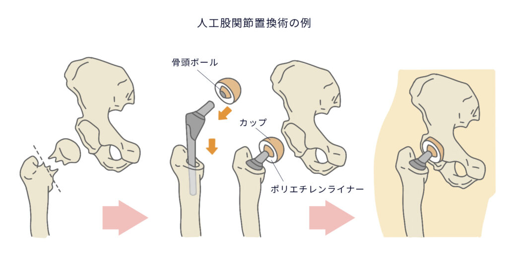 人工股関節置換術