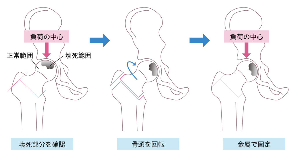 関節温存手術