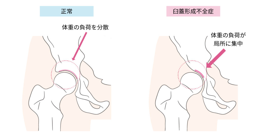 臼蓋形成不全症