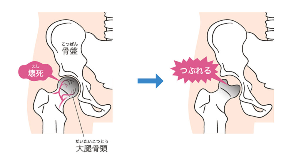 特発性大腿骨頭壊死症