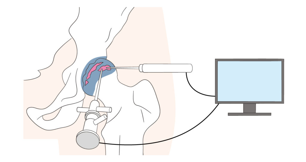 股関節鏡視下手術