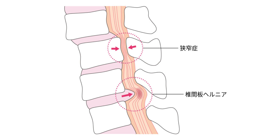 椎間板ヘルニア