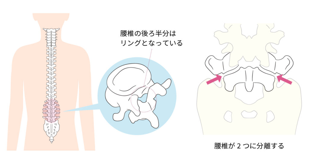 腰椎分離すべり症