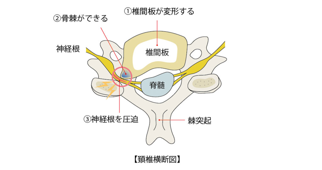 頚椎症性脊髄症