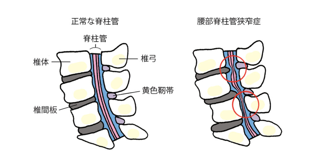 腰部脊柱管狭窄症