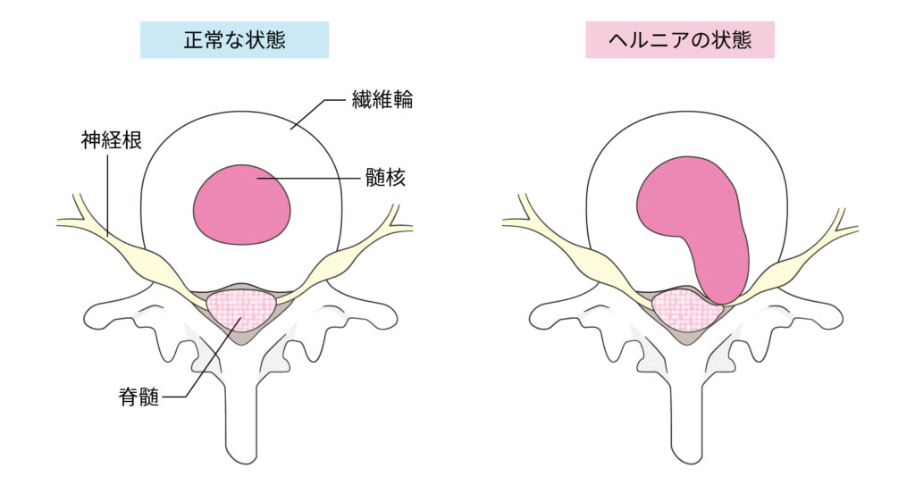 ヘルニアの状態