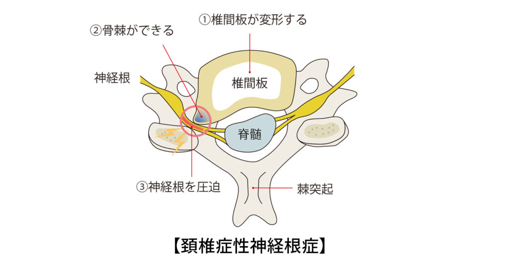 頚椎症性神経根症