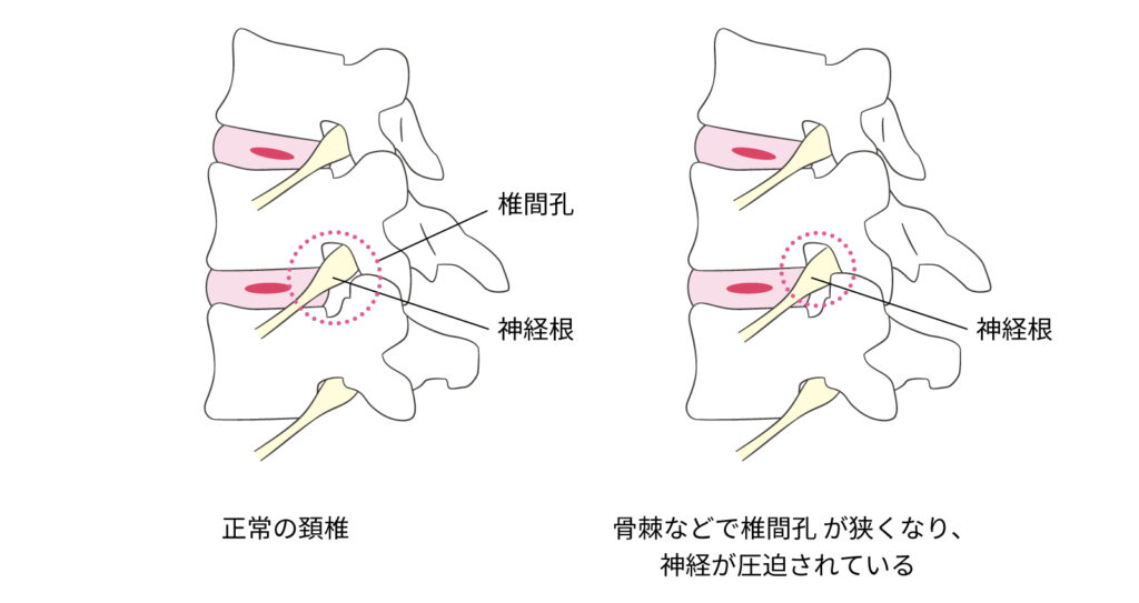 TOH03_頚椎椎間板ヘルニア_01-01