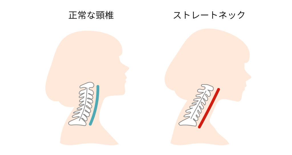 正常な頸椎とストレートネック