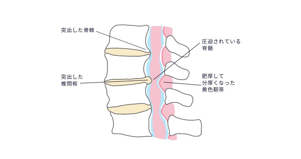 脊椎_術式_頸椎_頸椎狭窄02 (1)